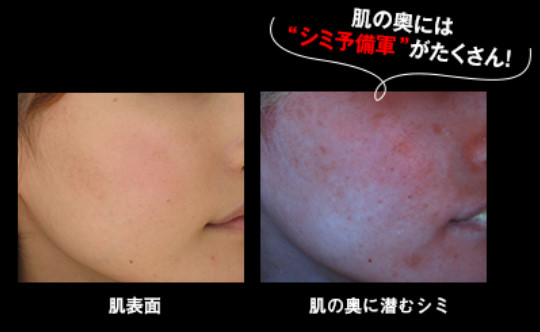 肌の奥にひそむシミ予備軍